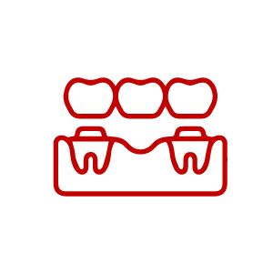 Dental Crowns and Bridges